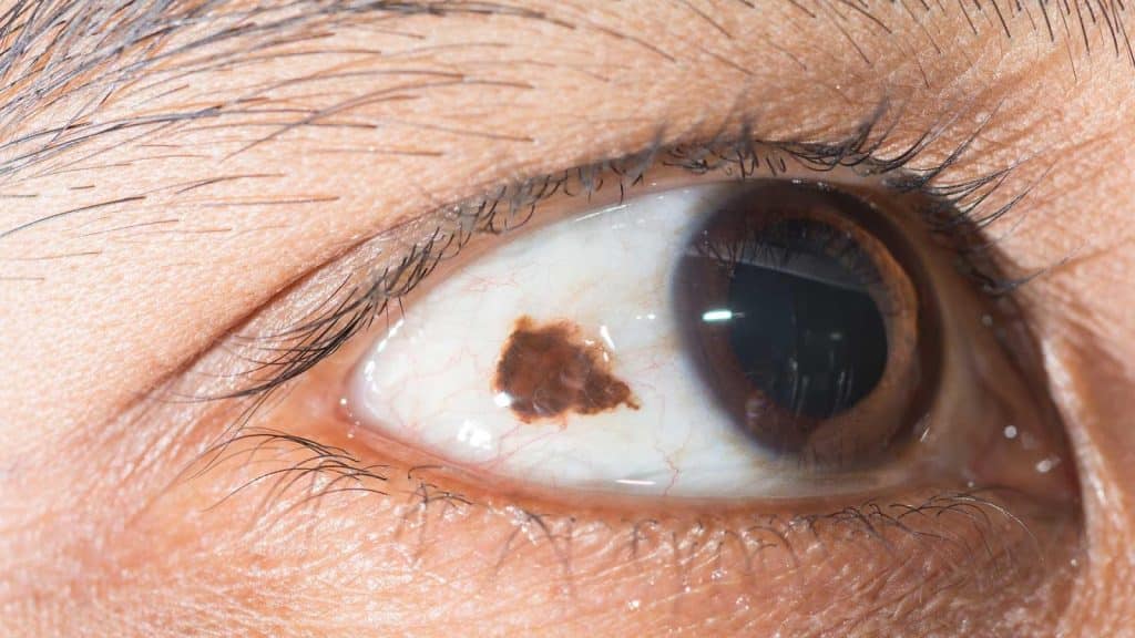 Image 1 of Argon Laser Conjunctival Naevus Treatment – The Laser Treatment You Didn’t Know You Could Have