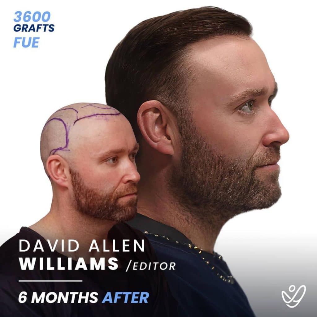 Image 1 of The popularity of Turkish hair transplants reached mainstream audiences when members of Barstool Sports filmed their own journeys to Istanbul. Their treatment was carried out with