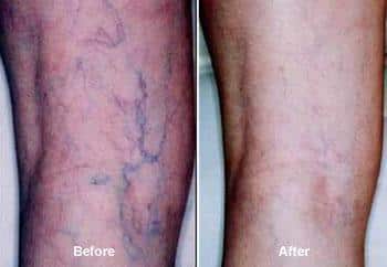 Image 1 of Top 7 Vein Therapy Procedures With Real Results 2025