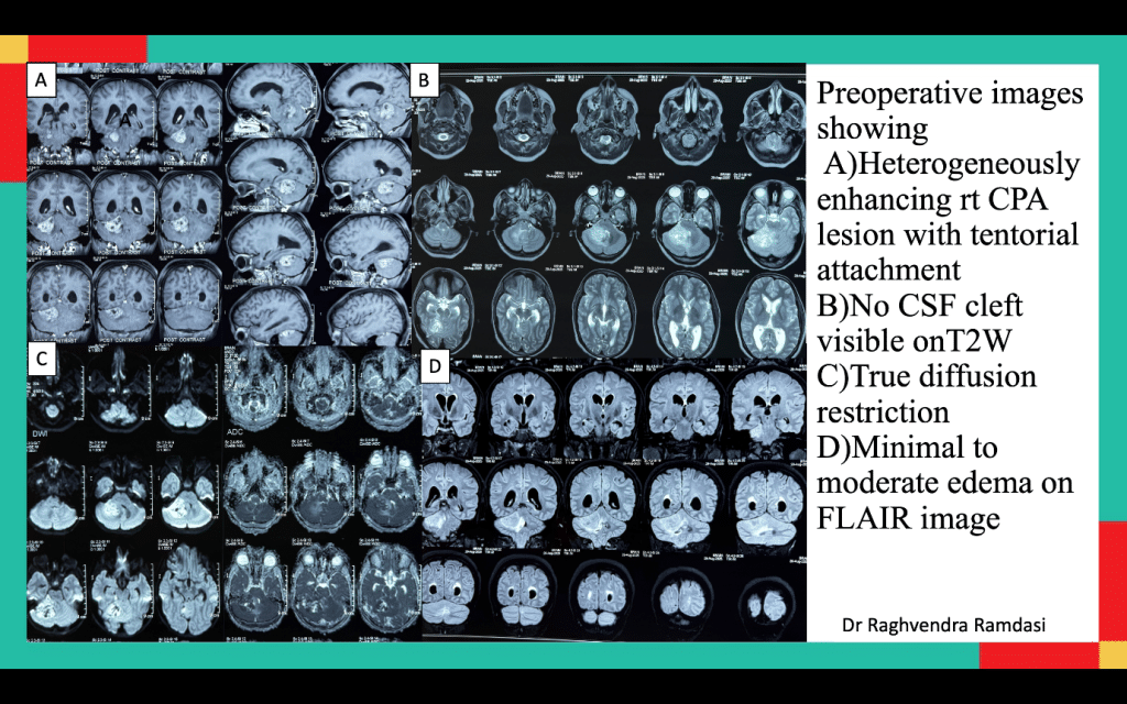 When a Common Brain Tumor Isn’t So Common: A Rare Case of CPA Medulloblastoma In An Adult Image 1 of When a Common Brain Tumor Isn’t So Common: A Rare Case of CPA Medulloblastoma In An Adult