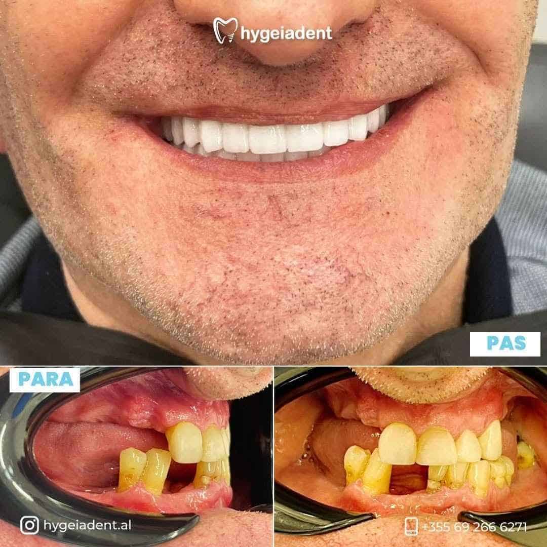 Before and after dental implants in Albania