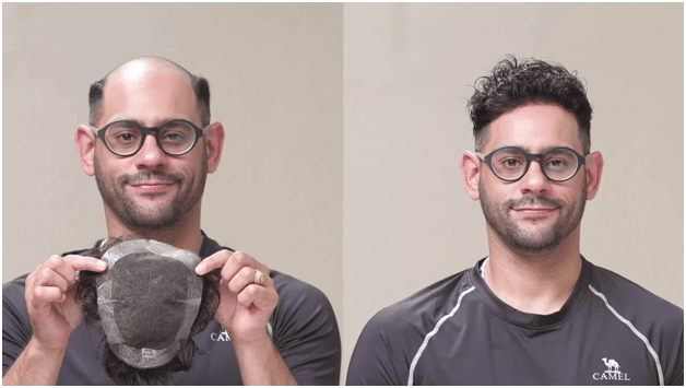 Image 1 of Non-Surgical Confidence: Quick and Temporary Perfect Hairline Solutions