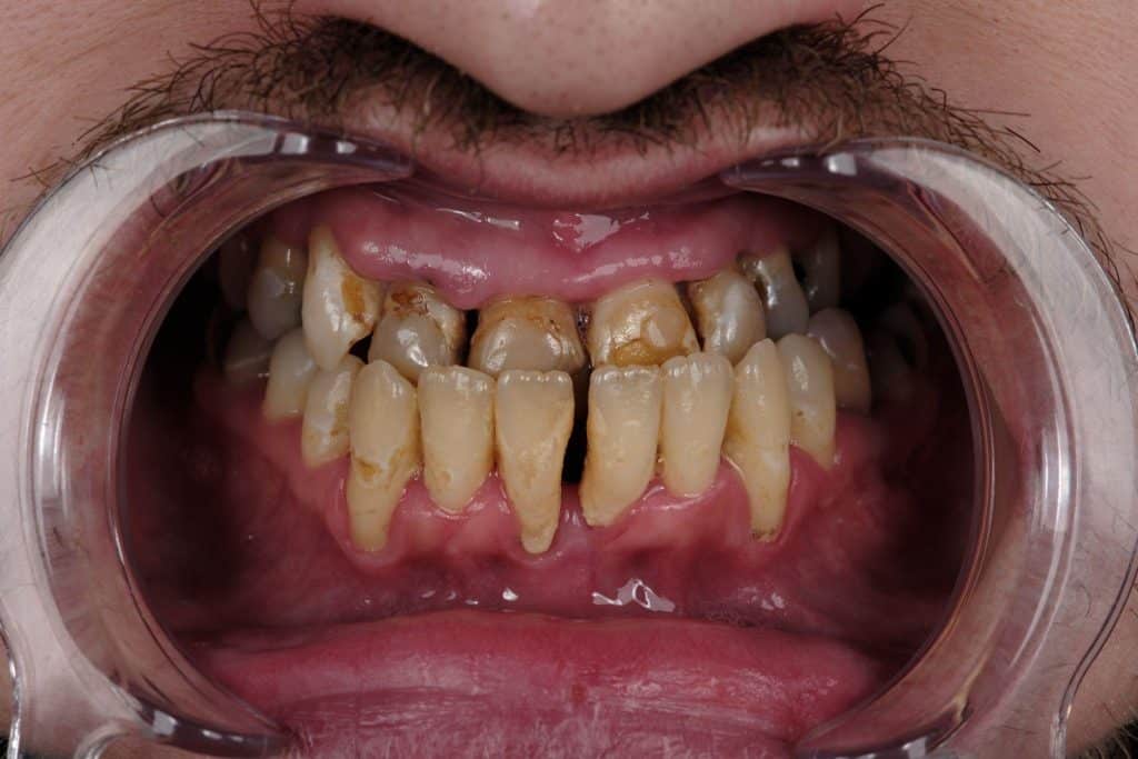 Image 1 of Can Zirconium Crowns Correct an Underbite Without Surgery? A 2026 Case Study